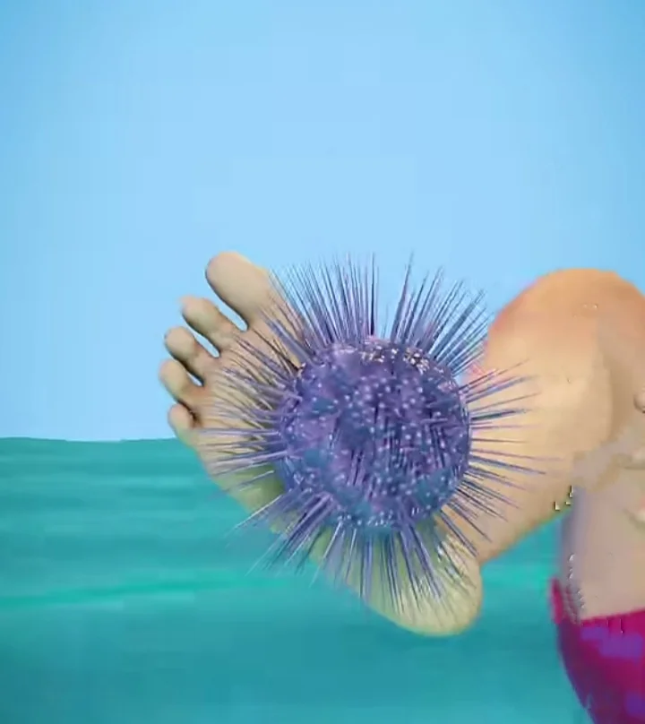 How to Remove Sea Urchin Spines